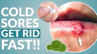 How to Get Rid of Cold Sore Fast