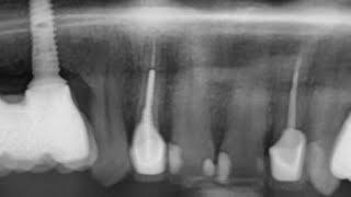 Immediate dental implant placement @dentiumworld @DrAnwarAlabdullah