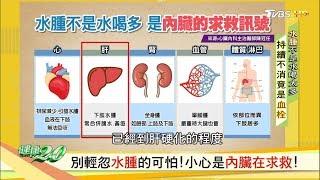 別輕忽水腫的可怕！小心是內臟在求救！ 健康2.0