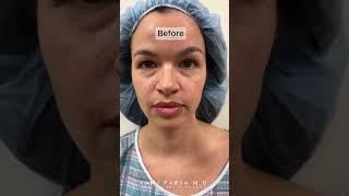 11 Weeks After Quadfecta Lift with Dr. Kami Parsa | Hooded Upper Eyelids & Lower Eye Bags Treatment