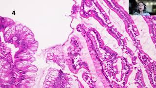 Tip-98;Pancreatic Intraductal Papillary Mucinous Neoplasm (IPMN), with Colloid Carcinoma