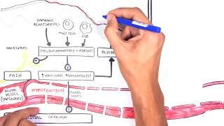 Burns (DETAILED) Overview - Types, Pathophysiology, TBSA