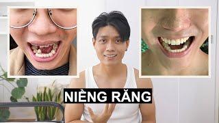 Niềng răng và những sự thật ai cũng nói dối bạn