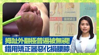 健康360 TVB｜拇趾外翻極普遍被無視! 惡化可損腰骨、膝頭｜胡存孝物理治療師示範紓緩伸展動作 邵貴明醫生講解錯用矯正器後果｜高跟腳、扁平足是最大元兇?｜最強生命線 黃靖婷