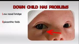 Mongolian, epicanthic folds, Down syndrome, fetal all syndrome, upper eye lid cover inner cornner of