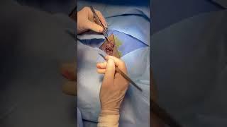 Labiaplasty wirh Clitoral Hood Reduction