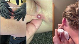 Popping Huge Blackheads and Pimple Popping - Best Pimple Popping Videos 22