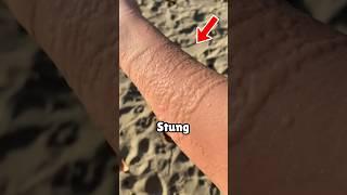 How To Survive a Jellyfish Sting 