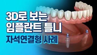 3D 영상으로 살펴보는 임플란트 틀니 치료방법과 사례들