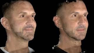 Male dermal fillers before & after results, at Quinn Clinics Bristol