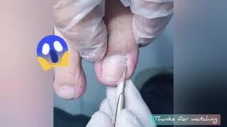 Cut Ingrown Toenail Satisfying / Healthy Feet 剪大向内生长脚趾甲#40