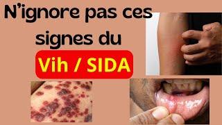 Quels sont les 13  signes du VIH / SIDA ?