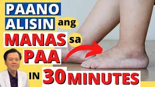 Paano Alisin ang Manas sa Paa in 30 minutes - Payo ni Doc Willie Ong #1442