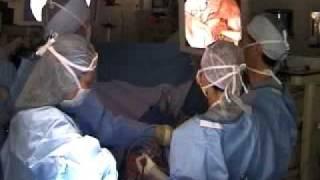 Video Assisted Thoracic Surgery (VATS)