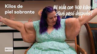 La realidad de tener kilos de piel sobrante | Mi vida con 300 kilos: ¿Qué pasó después?