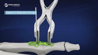 MTP Fusion Surgical Technique Animations (3 surgical Options) Double Medical Marathon Fusion System