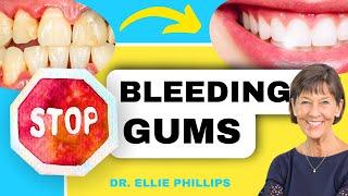 How To QUICKLY Treat Gingivitis and Bleeding Gums