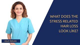 What Does The Stress Related Hair Loss look Like?