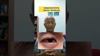 Konjungtivitis (Mata Belekan)| dr. Basuki Rokhmad