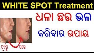 ଧଳା ଛଉ ଭଲ କରିବାର ଉପାୟ | White spot treatment in Odia | Vitiligo treatment in Odia | ODIA HEALTH TIPS