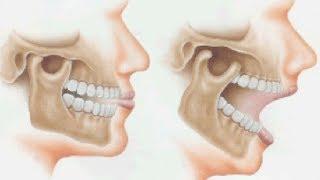 Orthotropic Treatment of Jaw Joint/Temporomandibular Disorder (TMD) by Dr Mike Mew