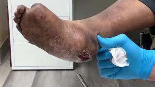 DIABETIC HEEL ULCER DOWN TO BONE / FOOT AT RISK FOR LOSS 