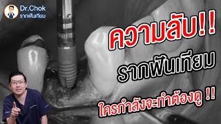 รากฟันเทียมคืออะไร ? ใครจะทำรากฟันเทียมต้องดู !!! | คลายปัญหารากฟันเทียมกับหมอโชค