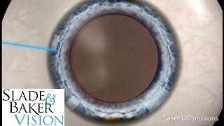 Modern vs Traditional Cataract Surgery - Dr. Bennett Walton, Slade & Baker Vision