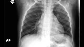 Chest X ray Child