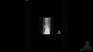 Acute Compartment Syndrome Xray #meded #trauma #orthopedicsurgeon #criticalcare