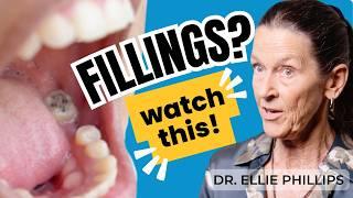 The Shocking Truth of Dental Fillings