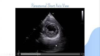 Echocardiography Conference (Dilated CS)