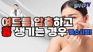 여드름 압출하고 흉 생기는 경우? - 필수시청! [피부과전문의 피부심]