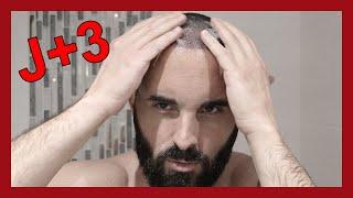 J+3 : Premier shampoing des greffons ! | MA 2ÈME GREFFE DE CHEVEUX