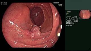 Endoscopic diagnosis of colon polyps using the NICE classification