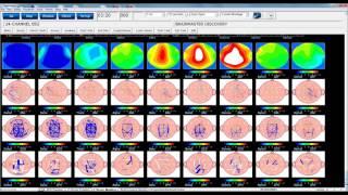 qEEG at Oxford Recovery Center