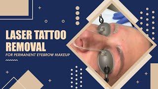 Laser Tattoo Removal for Permanent Eyebrow Makeup | Beverly Hills, CA | Dr. Jason Emer