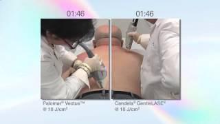 Palomar Vectus - Syneron Candela GentleLase