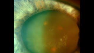 1 Slide in 5 Minutes: Phacolytic Glaucoma (Malik Y. Kahook, MD)