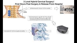 Four Hours after Hybrid Cervical Surgery due to Spinal Stenosis - Virginia Spine Institute - Pt 2