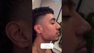 Cheek + Jawline Filler