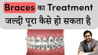 Braces का Treatment जल्दी कैसे पूरा हो सकता है | Braces treatment procedure | Seraphic dental Indore