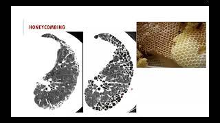 Usual interstitial pneumonia pattern English version