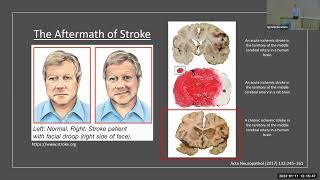 Targeting Foam Cells to Improve Stroke Recovery: Kristian Doyle, Ph.D.