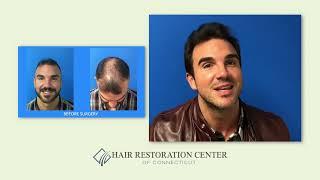 FUE Hair Restoration 7 Month Post-op Case Study - Scott Boden, MD