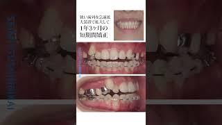 20代女性 短期間矯正治療 #歯 #歯医者#矯正歯科 #症例