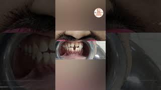 Dental Implants and Digital Smile Designing At Eledent Hospital || Best Dental Hospital || #shorts