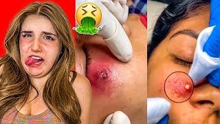 Grossest Pimple Popping Videos On The Internet