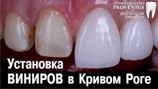 Где поставить виниры на кривые зубы: Украина, Кривой Рог, клиника Провентус