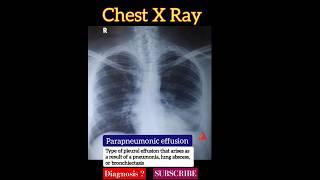 Parapneumonic effusion - Chest X Ray - Diagnosis - Radiology